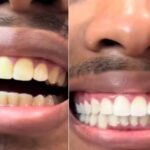 Descubra o miswak, o galho natural usado para clarear os dentes e que virou febre nas redes sociais. Veja onde comprar